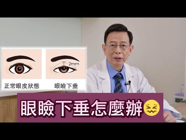 眼瞼下垂怎麼辦？【晶華美醫診所】徐典雄醫師｜台北眼瞼下垂手術 眼瞼下垂手術推薦 眼瞼下垂治療改善