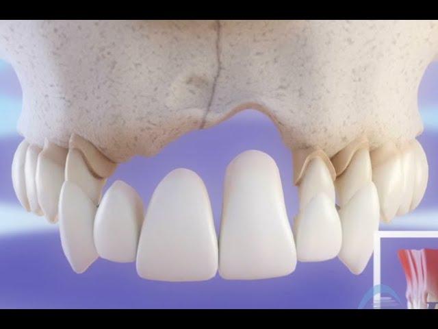 Зубные имплантаты VS Зубной мост - Сравнение ©