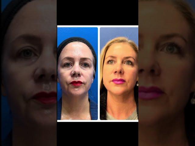 Reno/Tahoe Morpheus+CO2 Laser Healing from Skin Tightening and Resurfacing | Dr. Erez Dayan