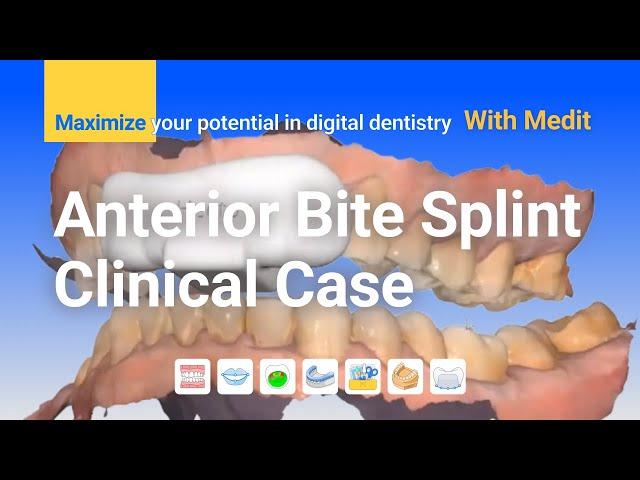 Clinical case - Anterior Bite Splint