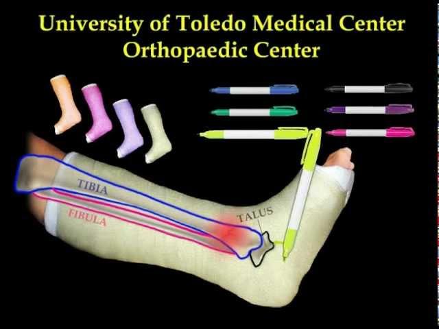 FRACTURED LEG - Everything You Need To Know - Dr. Nabil Ebraheim