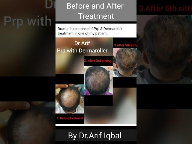 Before and After treatment || skin and hair treatment photos || Dr.Arif Iqbal