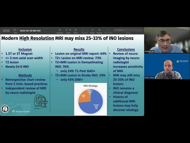 Internuclear Ophthalmoplegia INO on MRI