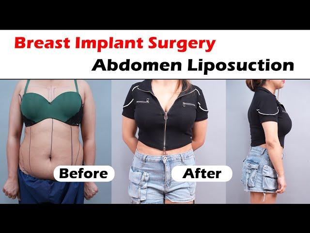 Breast Implant Surgery & Abdomen Liposuction result