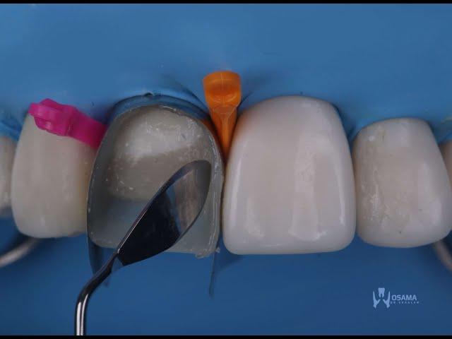 direct composite veneers with layering technique