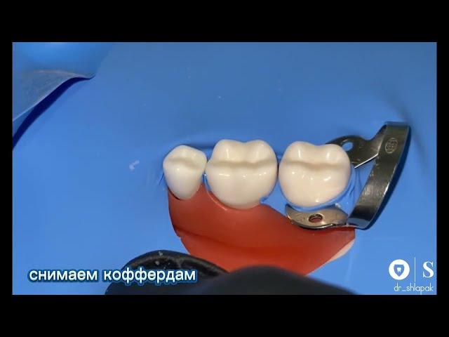 Изоляция жевательных зубов. Этапы постановки коффердама