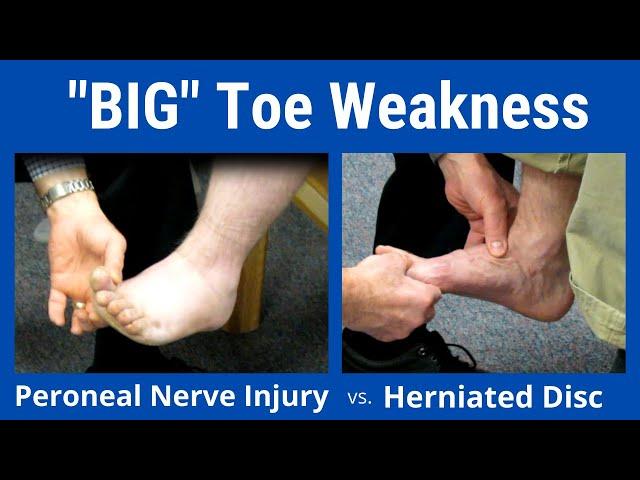 Big Toe Weakness: Peroneal Nerve Palsy vs. L5 Nerve Root Compression