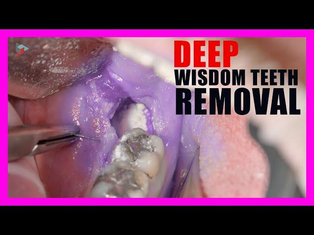 Wisdom Teeth Removal | Tooth Sectioning Procedure. Surgical Guide + Online Courses!