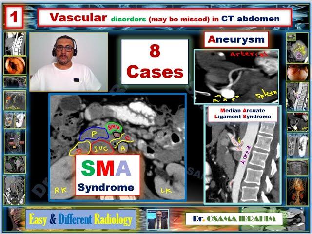 Radiology in GIT : 1- Vascular disorders (may be missed) in CT abdomen