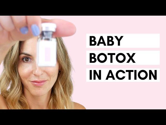 Baby Botox | Using a Dermastamp for Microneedling