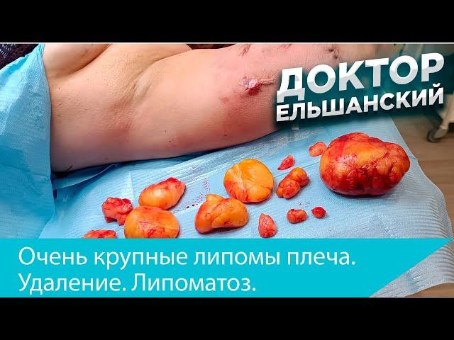 Очень крупные липомы плеча.  Удаление.  Липоматоз