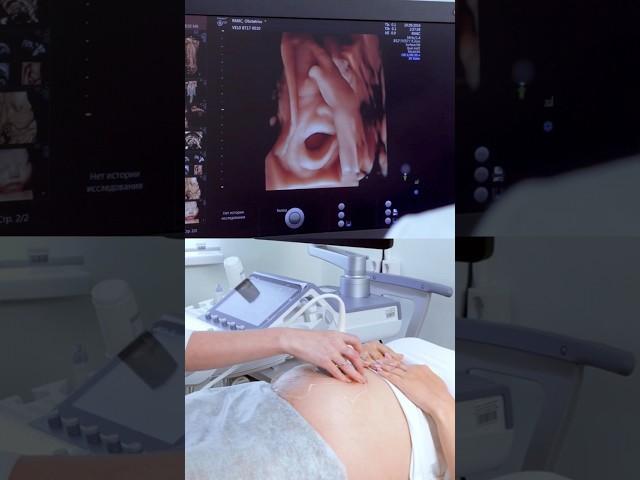 cute baby on ultrasound # #baby #babyultrasound #pregnant #ultrasoundpics