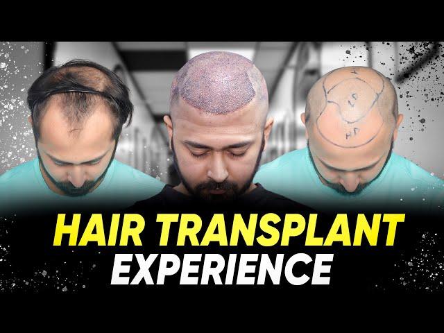 Hair Transplant in India | Best Results & Cost of Hair Transplant in India