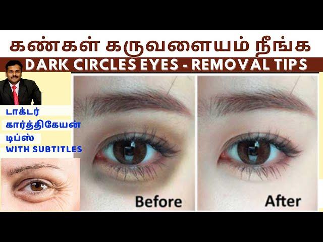 கண்கள் கருவளையம் உடனே நீங்க டிப்ஸ்|dark circles under eyes home remedies dr karthikeyan