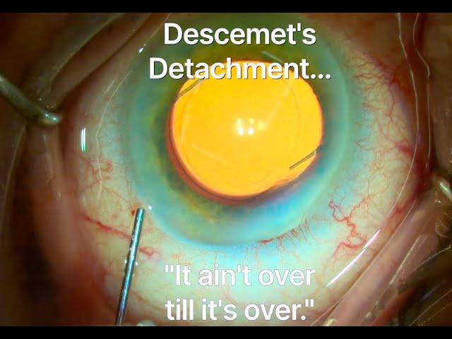 Descemet's detachment during cataract surgery.  "It ain't over till it's over." Shannon Wong, MD