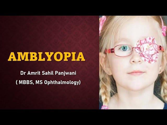 AMBLYOPIA ( lazy eye) EXPLAINED