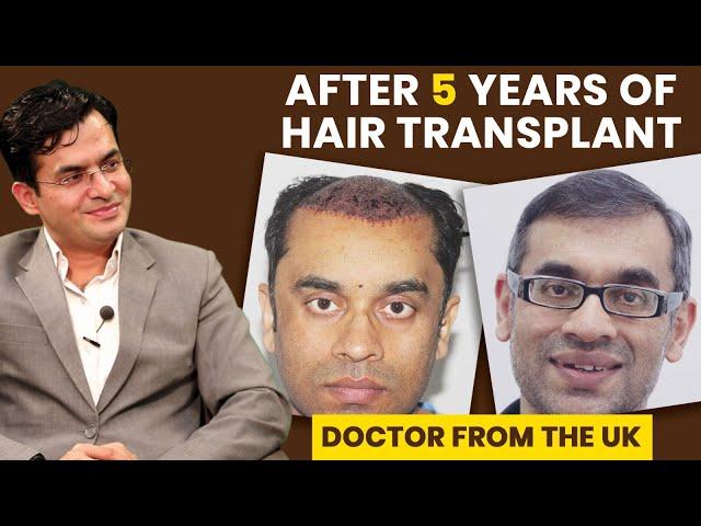 How do Hair Transplant Results look after 5 Years? | UK Doctor gets 5000 Grafts by Dr Suneet Soni