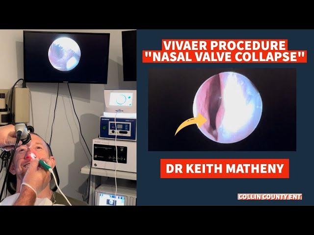 VIVAER PROCEDURE (NASAL VALVE COLLAPSE) WITH DR. KEITH MATHENY, COLLIN COUNTY ENT