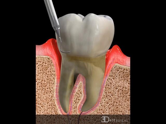 Periodontal Cleaning