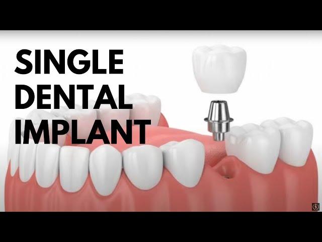 Single Dental Implant Procedure Animated