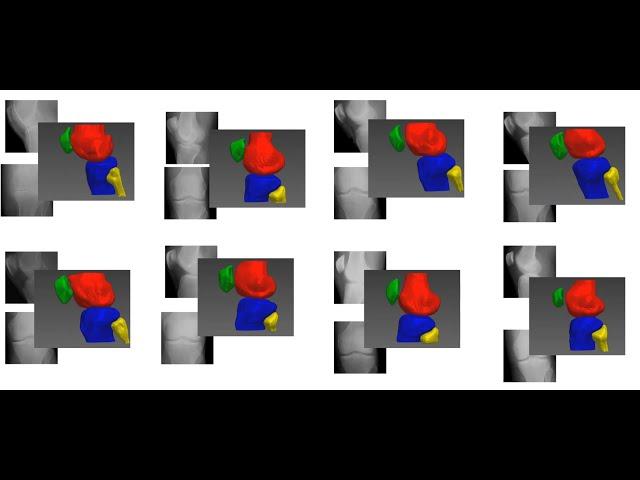 End To End CNN for 3D Reconstruction of Knee Bones From Bi-Planar X-ray Images by RSIP Vision