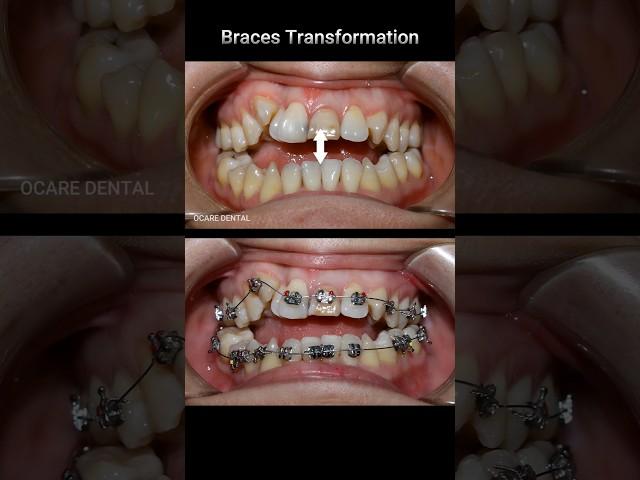 Braces transformation - open bite & crooked teeth #braces #dentist #orthodontist #dental