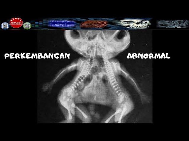 PERKEMBANGAN ABNORMAL - DIRGA BIOLOGY CHANNEL