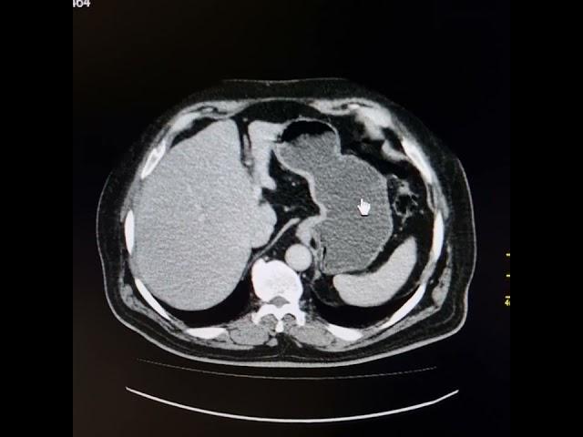 Malignant growth of pyloric canal and pylorus. Preoperative scan. Part 1.