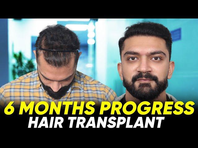 Hair Transplant in Turkey | Best Results & Cost of Hair Transplant in Turkey