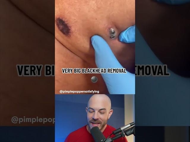 GIANT blackhead removal! #dermreacts #blackheadremoval #acneremoval