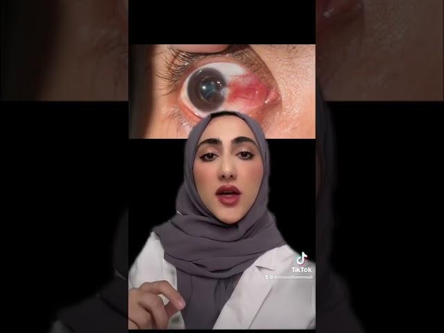 علاج ظفر العين (لحمية العين)