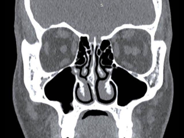 How to read a CT PNS |  All points Explained in detail