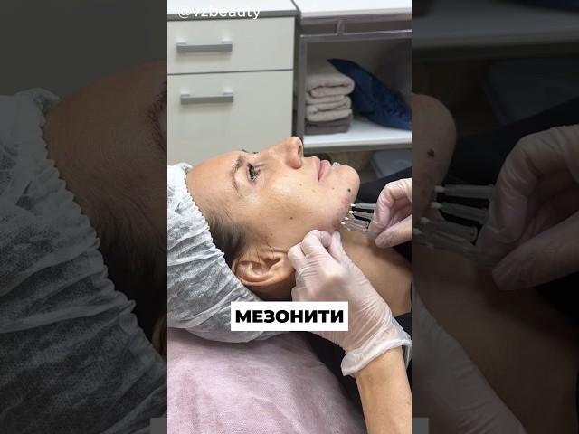 Укрепление кожи лица армируюшими мезонитями #косметология