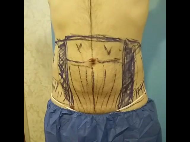 Vaser HI-Definition PowerX Liposculpture, Abdomen, Flanks, Back by Dr. Lebowitz, Long Island, N.Y.