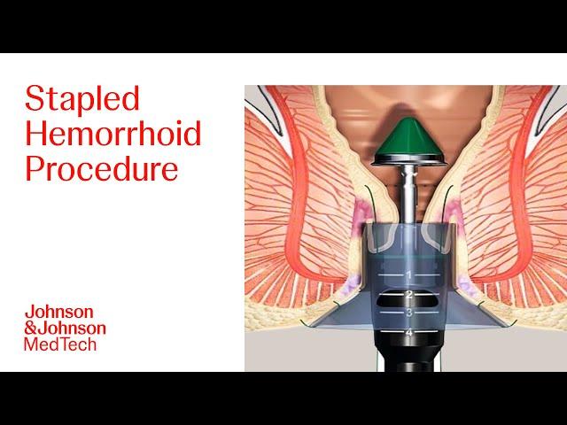 PPH Procedure Animation | Stapled Hemorrhoid Surgery | J&J MedTech