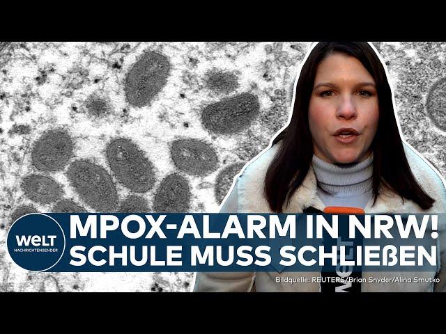 NRW: Mpox-Alarm! Neue Variante in Deutschland aufgetaucht! Schule in Rösrath bei Köln muss schließen