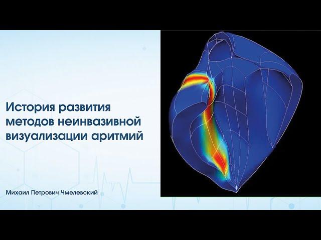 История развития методов неинвазивной визуализации аритмий
