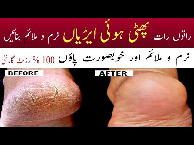 Homemade cracked heels cream with  Candle |% Results | Baby Soft Beautiful Heels