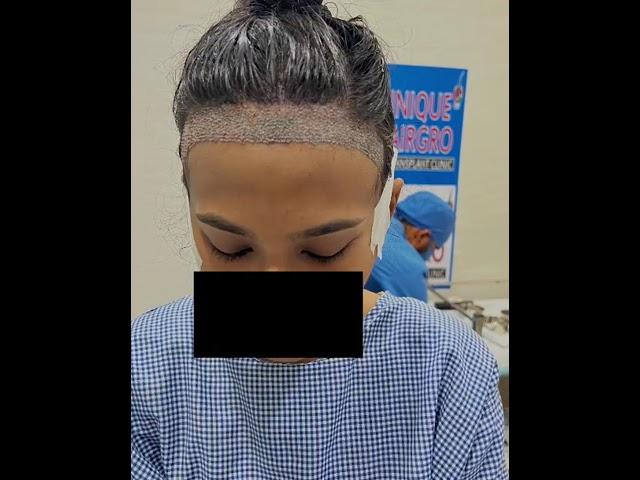 Female Hair transplant | Unique Hair grow Chennai | best hair transplant in chennai