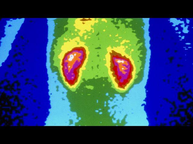 A Man Took 1176 Ibuprofen Tablets In A Month. This Is What Happened To His Kidneys.