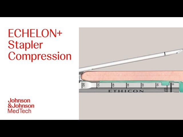 Examining Compression with ECHELON+ Powered Stapler with GST Reloads | J&J MedTech