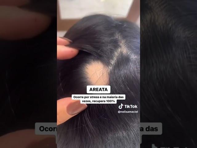 TIPOS DE QUEDA DE CABELO