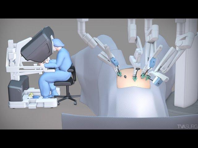 Robotic hysterectomy for high BMI patients | TVASurg