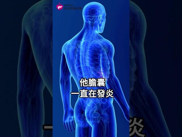 【發現有膽結石，該開刀嗎？】好心肝肝膽腸胃科林姿伶醫師認為，超過三公分或是開始作怪就要注意了！ ＃膽結石 ＃膽囊 ＃膽囊癌
