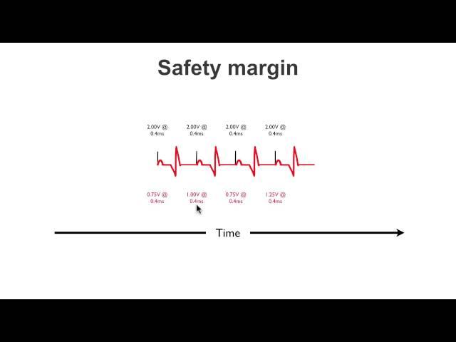 Pacemaker Issues Explained (Part 1): Understanding Failure to Capture