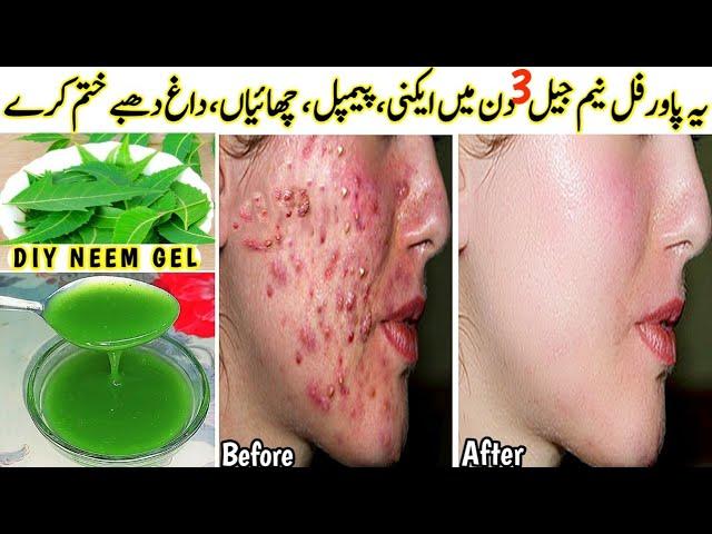 I appliedthis DIY Neem Gel on Acne, Pimples, Pigmentation,Bumps - Got Clear Glowing Skin In 3 Days