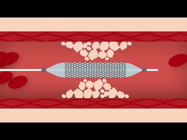 Heart Stent Procedure