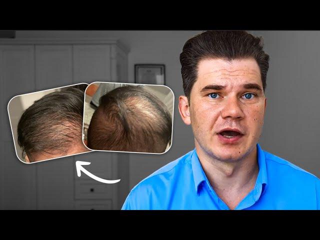 Can He Restore Hair By My Regrowth Routine?