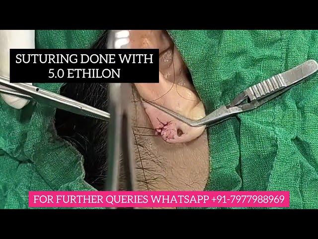 EAR LOBULE REPAIR UNDER LOCAL ANESTHESIA| DR VICKY JAIN #earloberepair #earrings #plasticsurgery