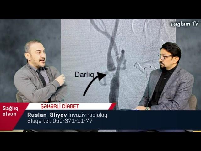 ŞƏKƏR XƏSTƏLİYİ. ŞƏKƏRLİ DİABET. İNVAZİV RADİOLOQ RUSLAN ƏLİYEV. TIXANMIŞ DAMARLARIN AÇILMASI